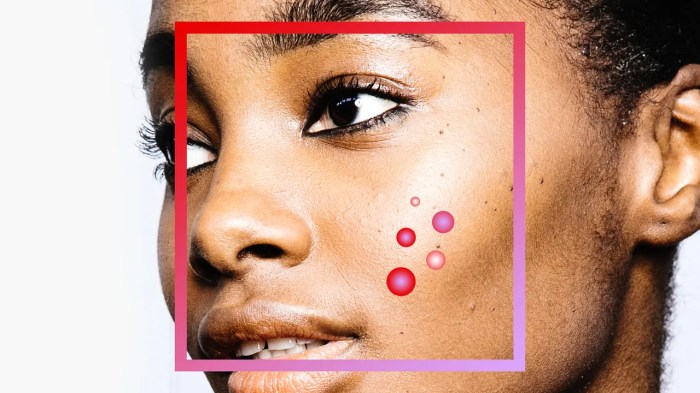Acne and stress