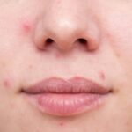 Acne atualizadas respostas affects saúde estresse afeta