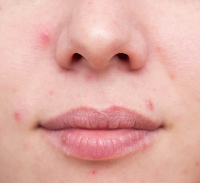 Acne atualizadas respostas affects saúde estresse afeta