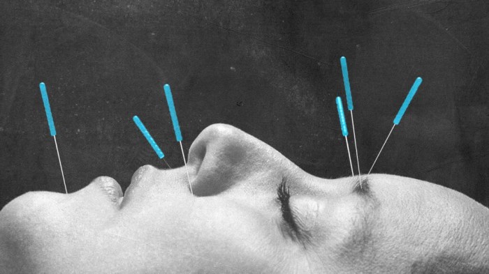 Acupuncture pressure points