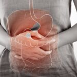 Acupuncture for digestion