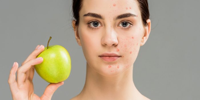 Acne connection diet simple between